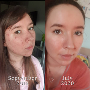 My Transformation to Beautiful Blemish-Free Skin