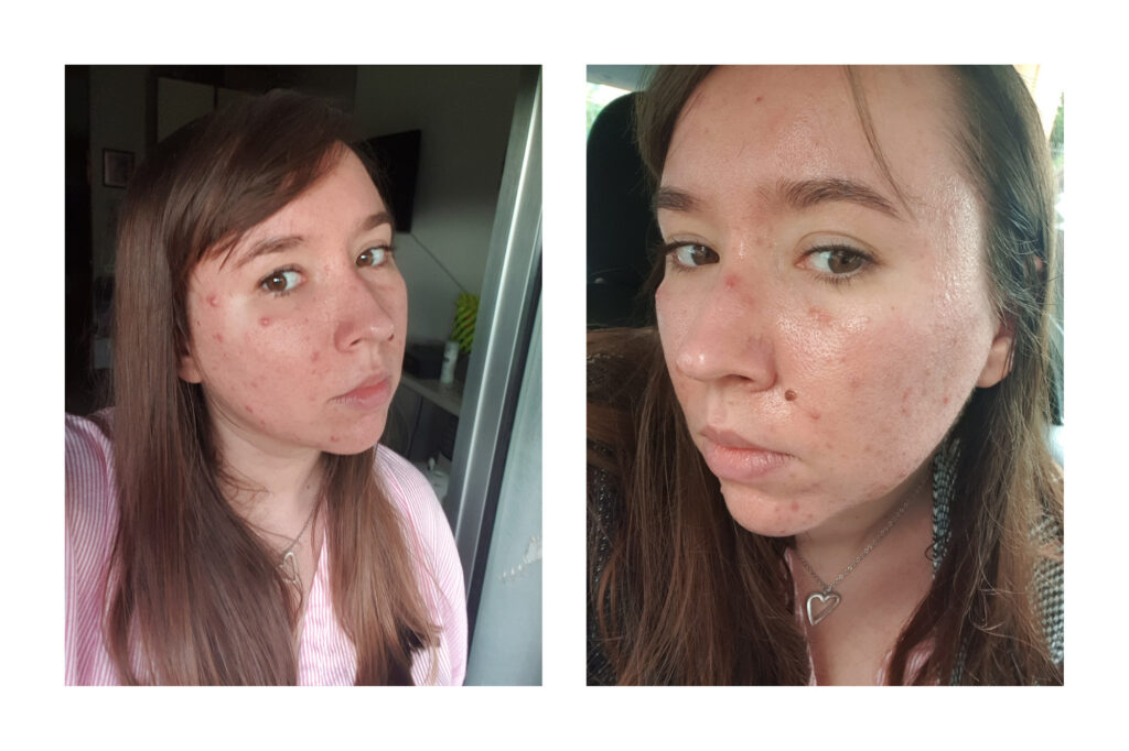 before pictures showing acneic skin, large blemishes